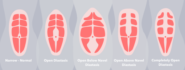 diastis_recti_grande